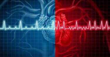 AFib