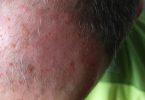 actinic keratosis