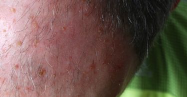 actinic keratosis