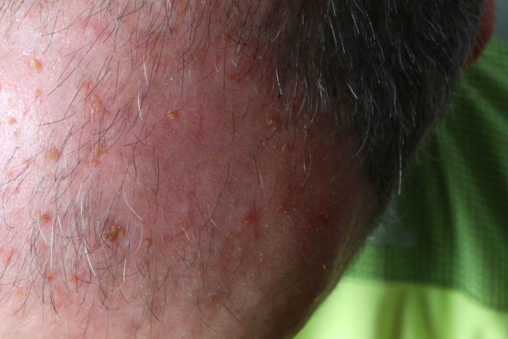 actinic keratosis