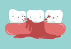 Periodontal disease