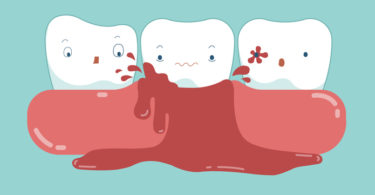 Periodontal disease