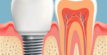 Teeth in a Day