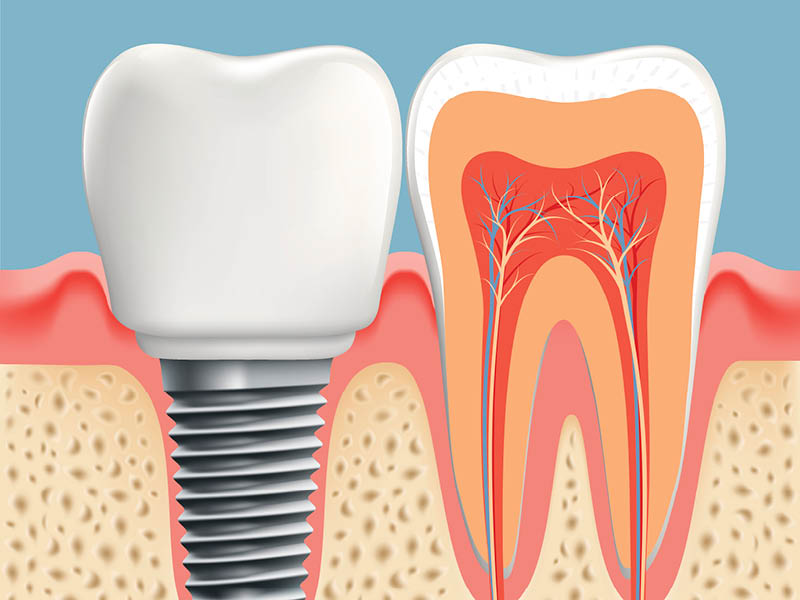 Teeth in a Day