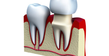 Do I really need a dental crown?