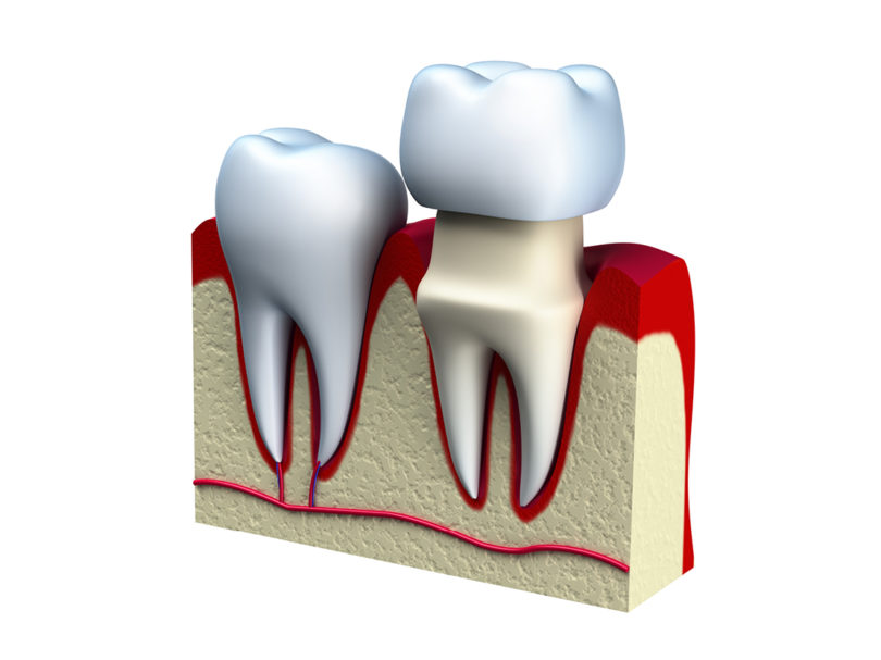 Do I really need a dental crown?