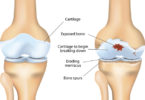 what is osteoarthritis of the knee pain