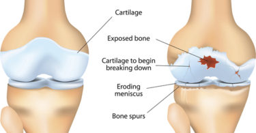 what is osteoarthritis of the knee pain