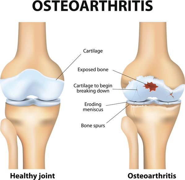 what is osteoarthritis of the knee pain