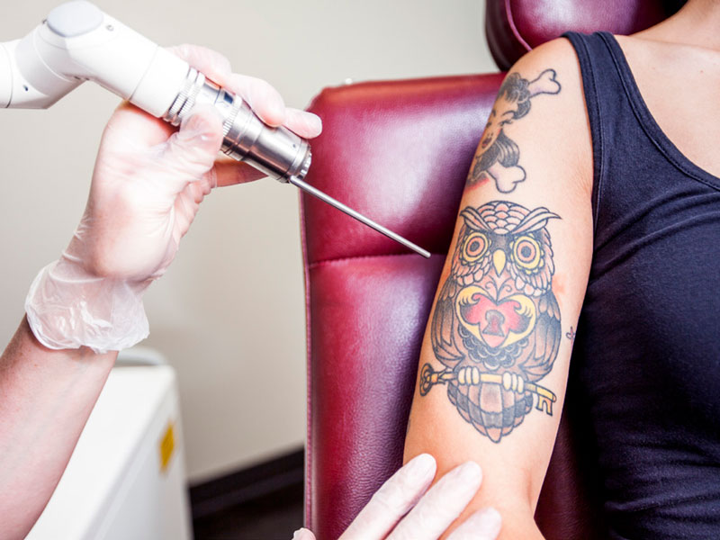 Tattoo Removal: The Modern Extraction of Ancient Art - Health Journal