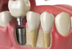 dental implants