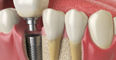 dental implants