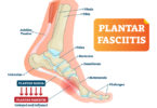 Plantar fasciitis heel pain