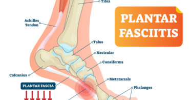 Plantar fasciitis heel pain