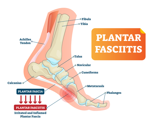 Plantar Fasciitis and Heel Pain 