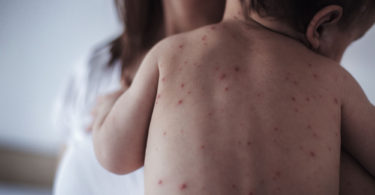 measles