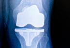 total knee replacement as outpatient