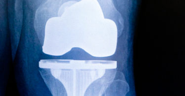 total knee replacement as outpatient