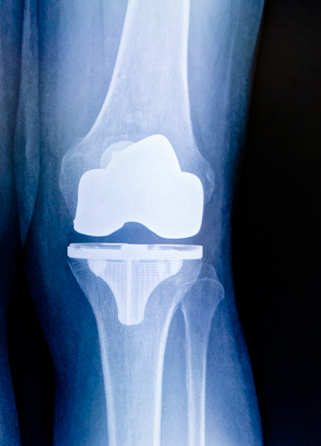 total knee replacement as outpatient